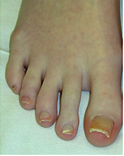 Bent toes straightened and toe shortened  by Foot Surgery Services