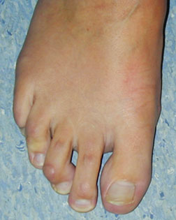 Mallet toe with Callouses
