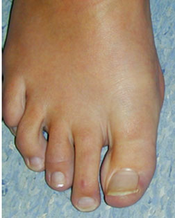 Mallet toe with Callouses treated by Foot Surgery Services