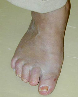 Big toe joint pain and inflamation sucessfully treated by Foot Surgery Services