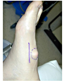Painful Bump on Foot