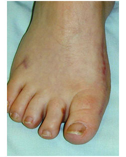 how a foot looks after bunion surgery at Foot Surgery Services