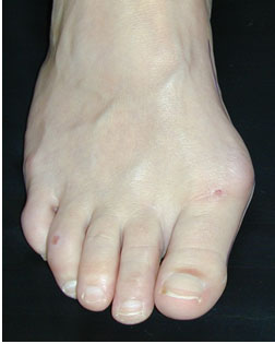 another bunion in need of Foot Surgery Services