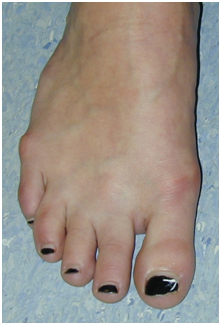 Bunion After Surgery