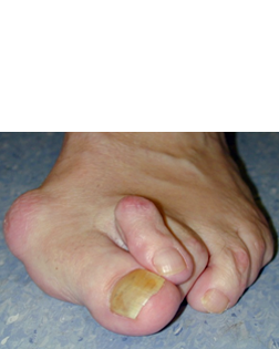 Bunion Deformity