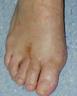 complex forefoot deformity resolved by Foot Surgery Services