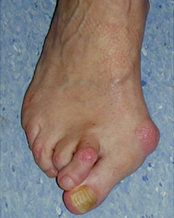 complex forefoot deformity