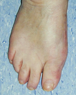 Hammer Toe resolved by Foot Surgery Services