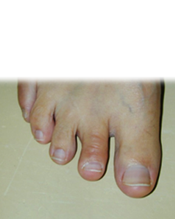 Hammer Toe and Corn treated by Foot Surgery Services