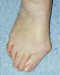 Hammer toe