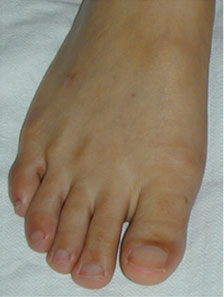 Big toe overlap resolved with Foot Surgery Services