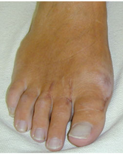 rheumatoidArthritisFeetCorrected-with-Foot-Surgery-Services.jpg