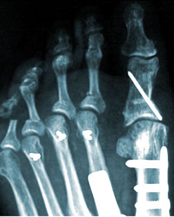 Severe Deviation of Small toes after Surgery by Foot Surgery Services