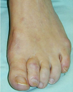 Severe toe overlaps and hammer toes relieved by Foot Surgery Services
