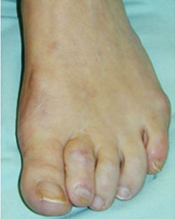 Severe toe overlaps and hammer toes relieved by Foot Surgery Services