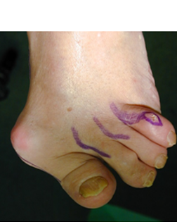 Severe Toe Deformity causing toe dislocation