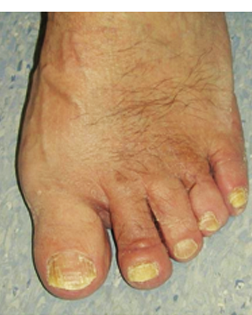 Severe Toe deformities corrected by Foot Surgery Services