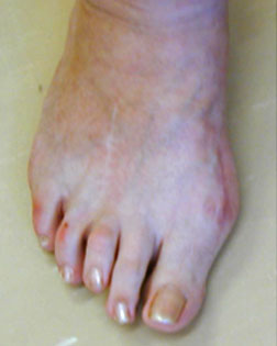 Surgery (not carried out by Foot Surgery Services) left short "floating" toe