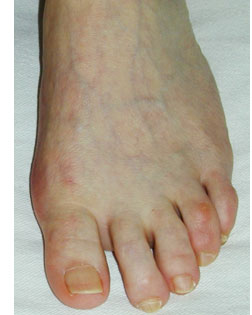 smaller Toes Alignment sorted with Foot Surgery Services