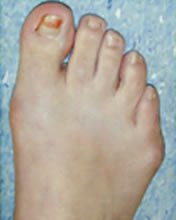 Tailors Bunion