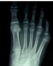 Tailors Bunion X-Ray