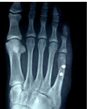 X-Ray of a Tailors Bunion Repaired by Foot Surgery Services
