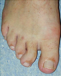 Thickened Toe