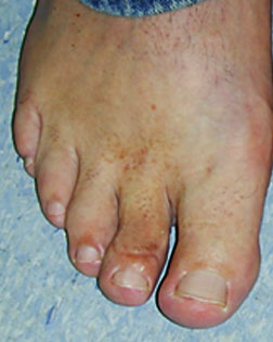 Thickened toe sorted by Foot Surgery Services