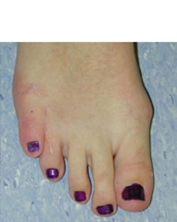 Little toe no longer crossing over and pain totally gone - thanks to Foot Surgery Services
