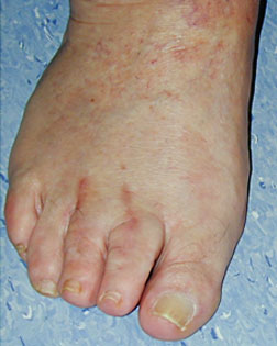 Toe Shortening carried out by Foot Surgery Services 