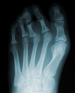 Toe Shortening Surgery Required after Bunion Surgery by another Practice